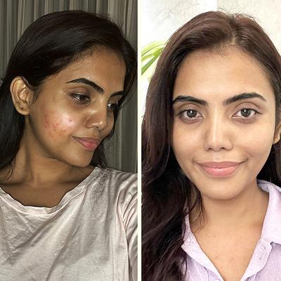 Plix The Plant Fix Pineapple Smoothie Moisturiser For Hyperpigmentation & Dark Spot Removal Unisex 30 gm - Face Moisturizers