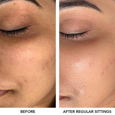 Professional O3+ Meladerm Vitamin C Gel Bleach 96 gm - Face Gels