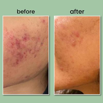 Bie - Beauty By Bie Beauty in Everything Calm Your Zits 20 gm - Face Moisturizers