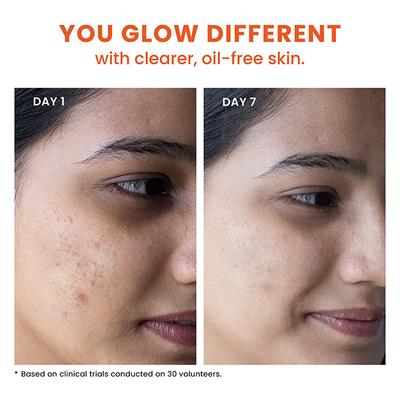 Foxtale Oil and Acne Control Face Wash - Fights Acne, Calms Skin, No Dryness 150 ml - Face Wash & Cleansers