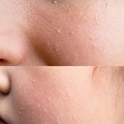 House of Beauty Milia Serum For White Cysts, Black & Whiteheads, Open Pores with Azelaic 15ml - Face Serum