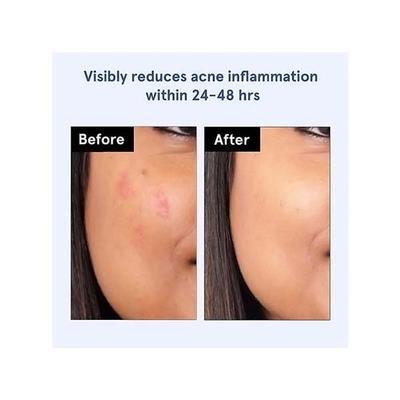 Be Bodywise Hydrocolloid Acne Patch for Instant Acne Treatment (24 Dots, 3 Sizes) 24's - Sheet Masks