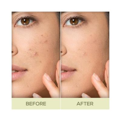 Renee Acne Filter 15 gm - Primer