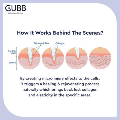 Gubb Derma Roller 540 Needles 0.5 mm 1's - Derma Rollers