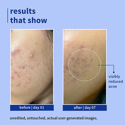 Plum 1% Salicylic Acid Gentle, Non-Drying Face Wash With Blueberr Helps Fight Active Acne 100 ml - Face Wash & Cleansers