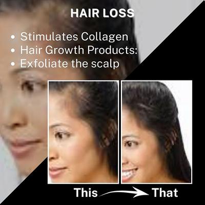 House of Beauty Derma Roller 1.00Mm For Home Use, Reduces Hairfall, Balding & Stretchmarks 1's - Derma Rollers