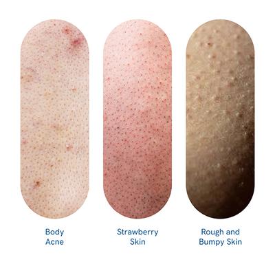 Be Bodywise 1% Salicylic Acid Be Body Wash for Be Body Acne 375 ml - Shower Gels & Body Wash