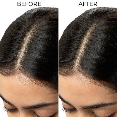 Brillare Lactylate Shampoo for itchy, flacky & dandruff prone Scalp 200 ml - Shampoos