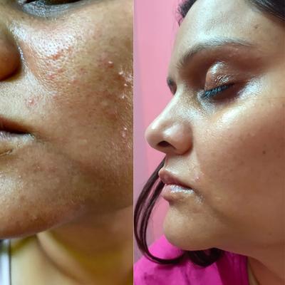 House of Beauty Acne Drying Serum For Pimpled, Oily & Open Pores Skin with Salicylic Acid 30ml - Face Serum