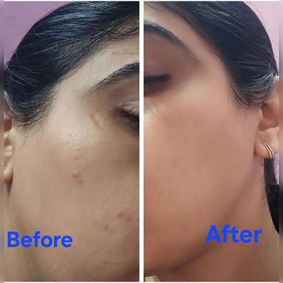 House of Beauty Acne Oil with Tea Tree, Avocado & Vit-E For Drying Pimpled & Oily Skin 10ml - Face Oils