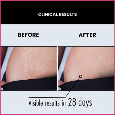 Thriveco Stretch Mark Expert Serum Cream 30 ml - Creams/Oils/Lotions