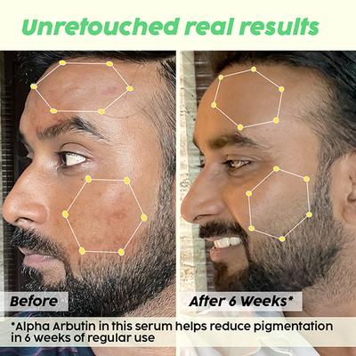 Plix The Plant Fix 2% Alpha Arbutin Pineapple Face Serum For Unisex With 10% 30 ml - Face Serum