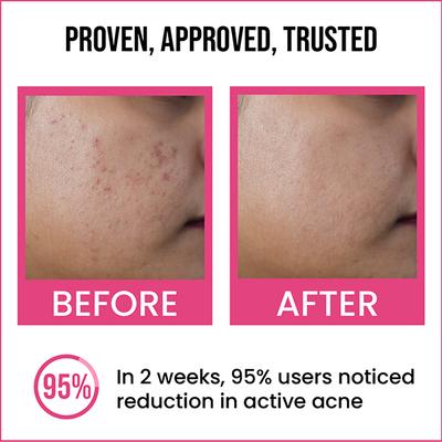 Insight Cosmetics 2% Salicylic Acid Active Acne Face Serum 30 ml - Face Serum