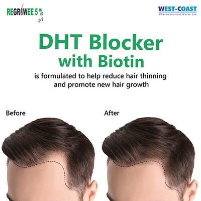 REGROWEE 5% Gel 50gm - Hair Loss-Oth