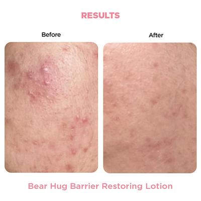 Resolve Bear Hug Barrier Restoring Lotion 50 gm - Face Moisturizers