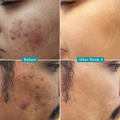 Pilgrim 10% Niacinamide Face Serum For Acne Marks 30 ml - Face Mists