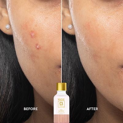 VLCC Clinic Acne Spot Relief 30 ml - Face Gels