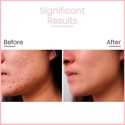 Anveya Goodbye Acne Serum With Niacinamide, Azelaic Acid & Hyaluronic Acid 30 ml - Face Serum