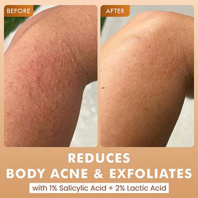 MCaffeine 7% Exfoliating Body Wash- 1% Salicylic 2% Lactic Acid, Shower Gel to Reduce Body Acne 300 ml - Shower Gels & Body Wash