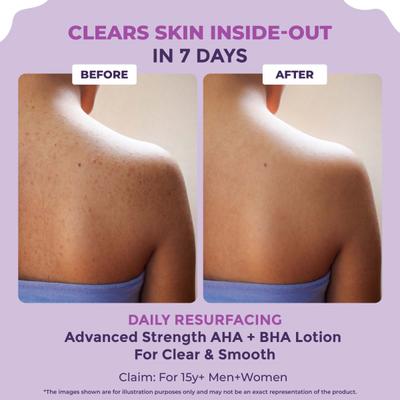 Sanfe Clear and Confident Glycolic Acid Body Lotion Daily AHA Lotion, Smooths Rough and Bumpy Skin 200 ml - Creams, Lotions & Oils