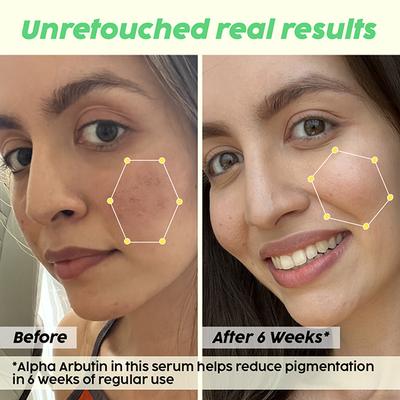 Plix The Plant Fix 2% Alpha Arbutin Pineapple Face Serum For Unisex With 10% 30 ml - Face Serum