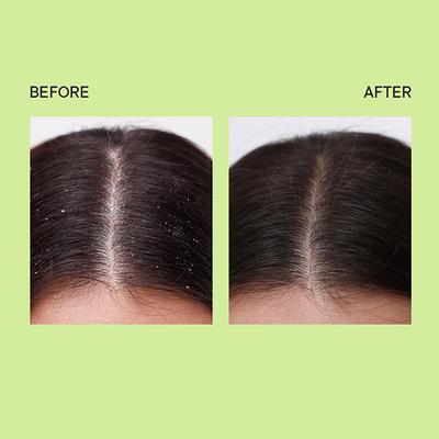 Quench Dandruff Control Ampoule with Tea Tree Extracts 100 ml - Hair Oils