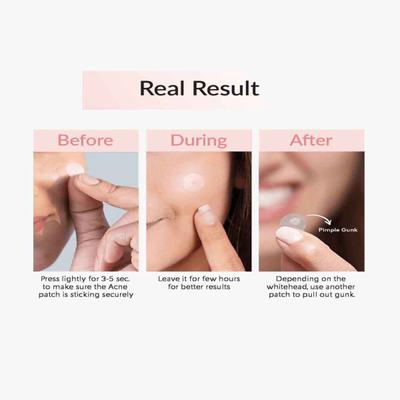 Priveda Spot clearing patch 57's - Face Creams