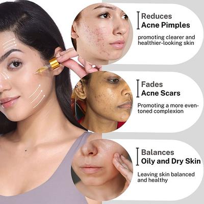 House of Beauty Acne Oil with Tea Tree, Avocado & Vit-E For Drying Pimpled & Oily Skin 10ml - Face Oils