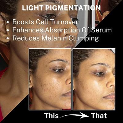 House of Beauty Derma Roller 0.50Mm Reduces Pigmentation, Fade Pimples & Acne Scars 1's - Derma Rollers