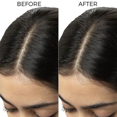 Brillare Tea Tree and Salicylic Oil Shots for Itchy, Flaky, Dandruff Prone Scalp 48ml - Hair Oils