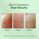 The Pink Foundry Acne Care & Healing Gel Moisturiser 50 ml - Face Moisturizers