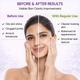 ACMED PLUS GENTLE PIMPLE CARE FOAMING Face Wash 150ml - Cleanser-Oth