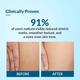 Fixderma Strallium Stretch Mark Cream 75 gm - Stretch Mark Cream