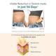 Inostretch Intensive Scar and Anti Stretch Mark Cream 60 gm - Skin-Treatment