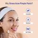 Sirona Acne Pimple Patch For Face (72 patches) - 2 Sizes, Invisible, Concealable, Waterproof Patches, Hydrocolloid & Salycylic Acid, Absorbs Acne Pus, Flattens Pimple for All Skin Types 1's - Sheet Masks
