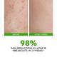 Conscious Chemist Acne Management & Prevention Serum 2% Salicylic Acid & Allantoin 30 ml - Face Serum