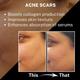 House of Beauty Anti Acne Foaming Facewash For Oily & Combination Skin with Salicylic 100ml - Face Wash & Cleansers