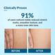Fixderma Strallium Stretch Mark Cream 75 gm - Stretch Mark Cream