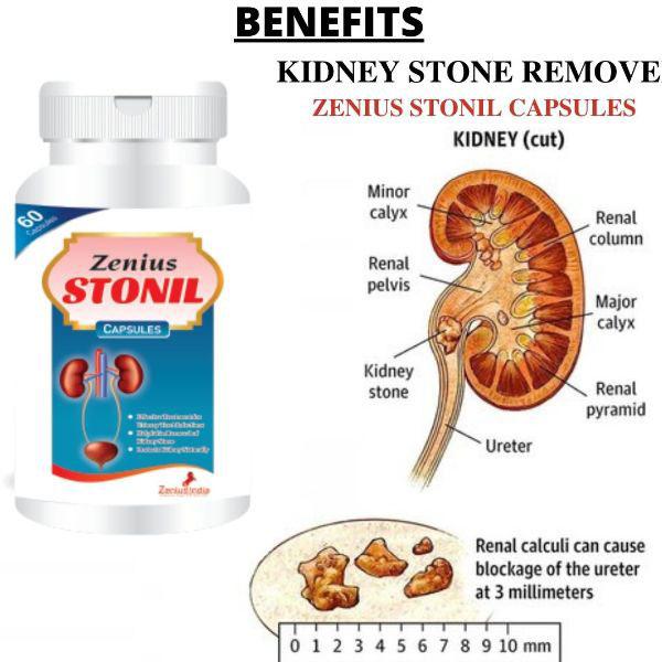Zenius Stonil Capsule 60's - Speciality Medicines