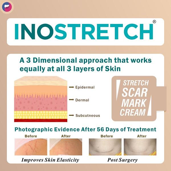 Inostretch Intensive Scar and Anti Stretch Mark Cream 60 gm - Skin-Treatment