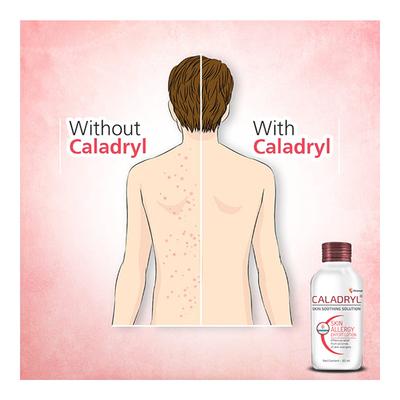 Caladryl Skin Soothing Solution 65 ml - Itching/Rashes