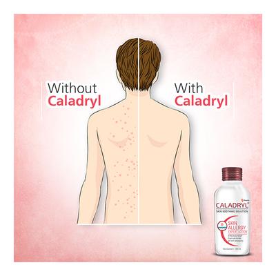 Caladryl Lotion 125 ml - Itching/Rashes
