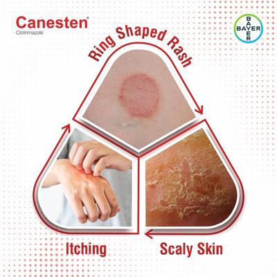 CANESTEN Topical Solution 30ml - Itching/Rashes
